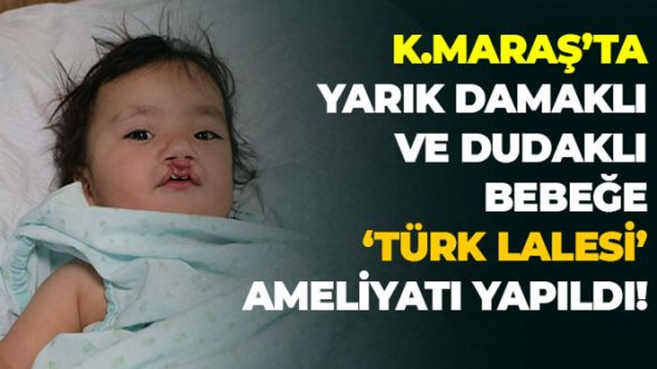 Kahramanmaraş'ta Yarık Damaklı Ve Dudaklı Bebeğe "Türk Lalesi" Ameliyatı Yapıldı