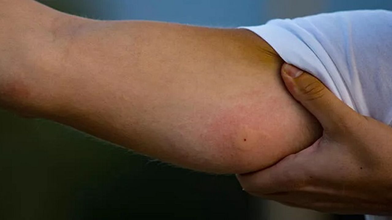 Böcek Isırığı Nedeni İle Doktora Gitti Hayatının Şokunu Yaşadı