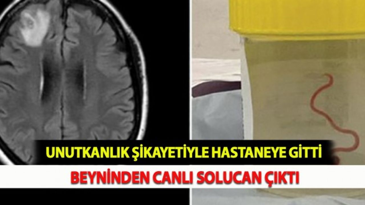 Unutkanlık Şikayetiyle Hastaneye Gitti Beyninden Canlı Solucan Çıktı