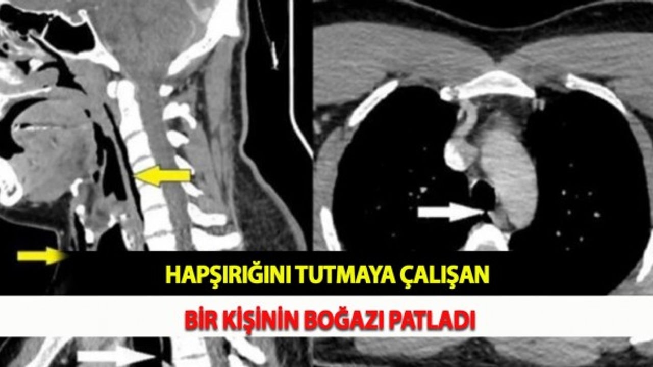 Hapşırığını Tutmaya Çalışan Bir Kişinin Boğazı Patladı