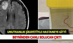 Unutkanlık Şikayetiyle Hastaneye Gitti Beyninden Canlı Solucan Çıktı