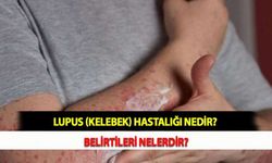 Lupus (Kelebek) Hastalığı Nedir? Belirtileri Nelerdir?