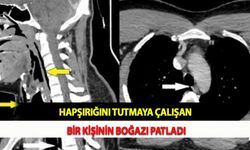 Hapşırığını Tutmaya Çalışan Bir Kişinin Boğazı Patladı