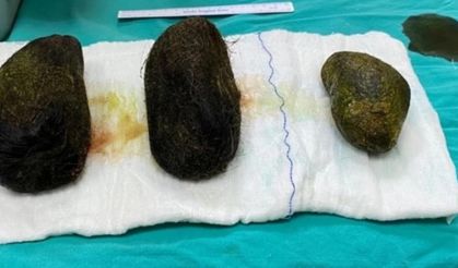 Karın Ağrısıyla Hastaneye Gitti, 40 Yaşındaki Kadının Midesinden Çıkanlara Görenler İnanamadı!